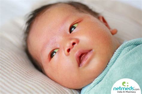 Newborns With Yellow Eyes