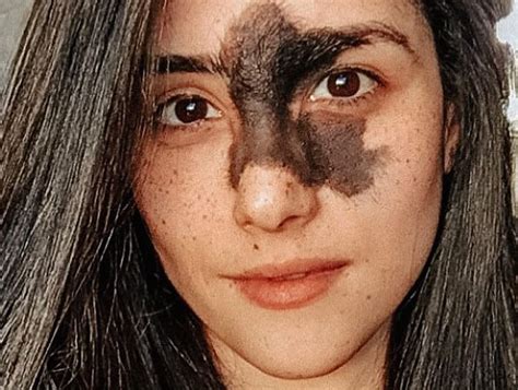 Living With Birthmarks What Are The Ones You Can And Cannot Remove