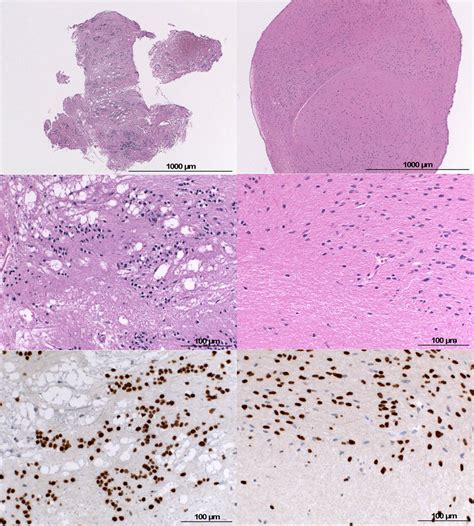 Diffuse Midline Glioma With Initial Histological Diagnosis Of