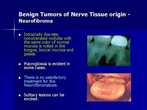 Benign Tumors Of The Oral Cavity Benign Tumors