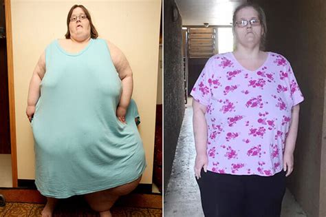 Gastric Bypass Before And After Pictures And How Life Will