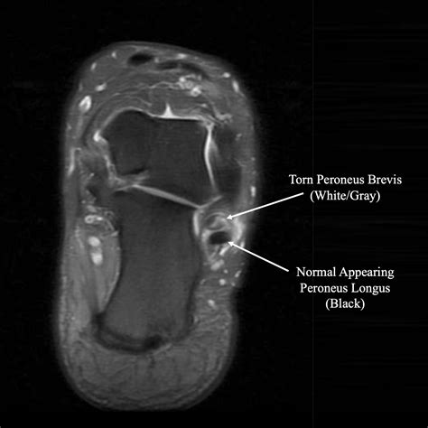 Peroneal Tears — Daniel Bohl Md Midwest Orthopaedics At Rush