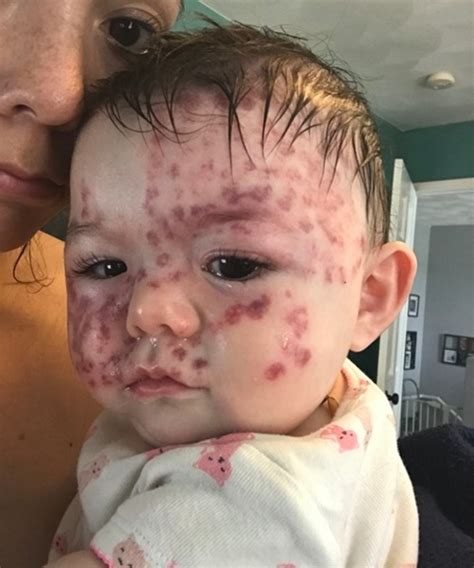 Polka Dot Cutie Spreads Awareness Of Rare Birthmark Parent24