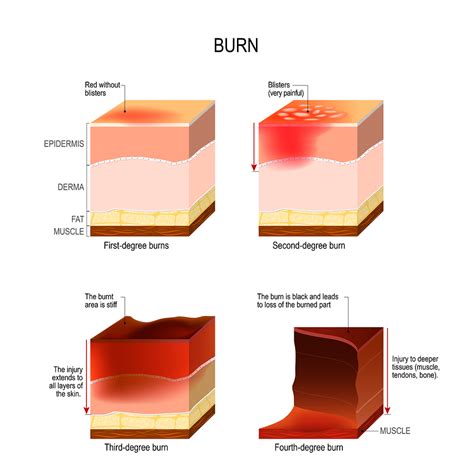 The Different Degrees Of Burn Wounds According To Ski