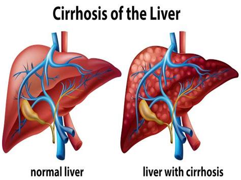 Cirrhosis Symptoms Causes Diagnosis And Treatment