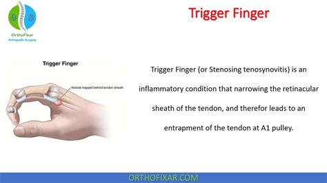 Trigger Finger Stenosing Tenosynovitis