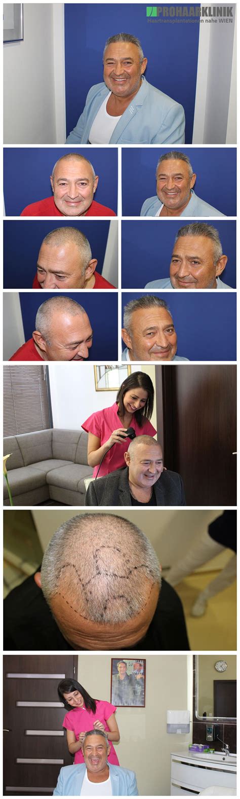 Hairmedic » 4600 fue grafts. Haartransplantation Vorher Nachher Bilder der ...