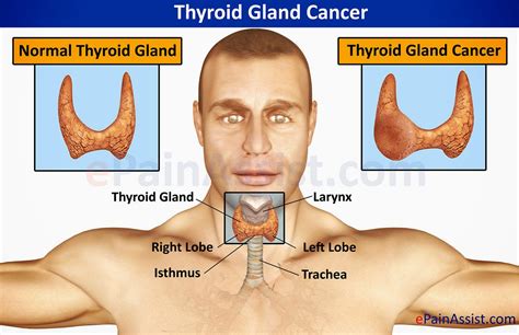 Wellness Lab Health Info How To Spot Thyroid Cancer