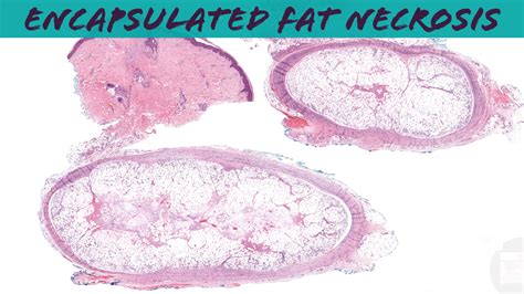 Post Traumatic Fat Necrosis Encapsulated Subcutaneous Fat Necrosis