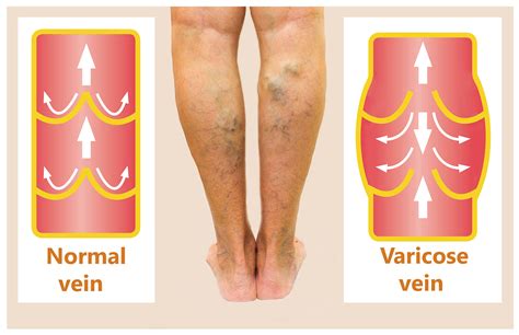 Varicose Veins Everything You Need To Know About Varicose Veins