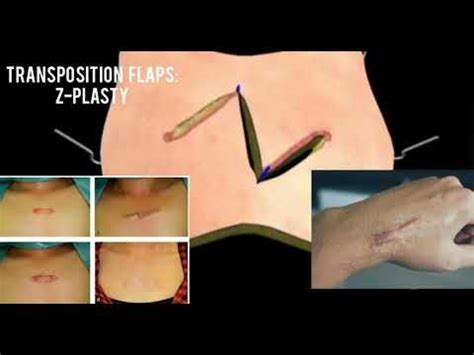 SKIN FLAP LIVE SURGERY PLASTIC AND RECONSTRUCTIVE SURGERY YouTube