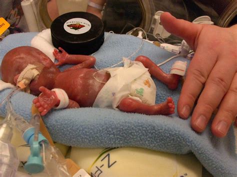 Micro Preemie Weighed Less Than 1 Pound At Birth Childrens Minnesota
