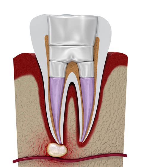 Apicoectomy Endodontic Surgery Dentist In North Syracuse Ny