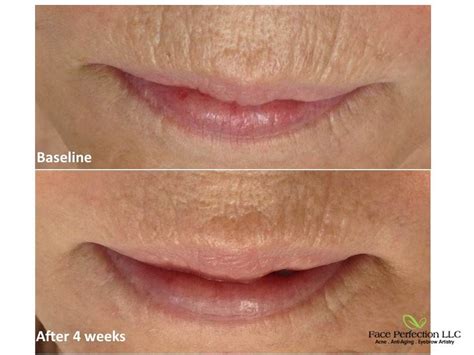 Microneedling Before And After Lip Lines Before And After