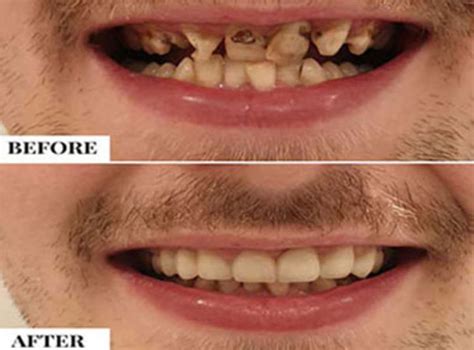 How To Fix Crooked Teeth In Adults
