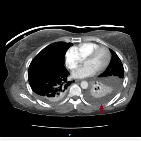 Ct Scan Of Chest Showing Left Sided Pleural Effusion Ct Computed