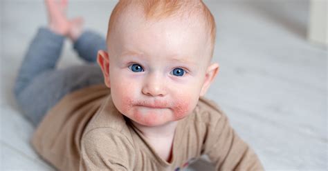Baby Eczema Signs Symptoms And Treatment Options For Baby Eczema