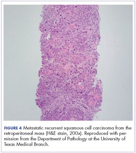 Recurrent Head And Neck Cancer Presenting As A Large Retroperitoneal