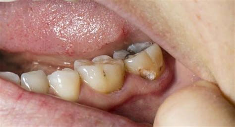 How To Tell If You Have A Cavity 5 Must Know Signs