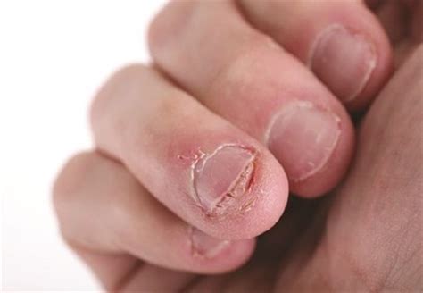 Nail Biting May Be A Hard Habit To Break But These Tips Can Help You