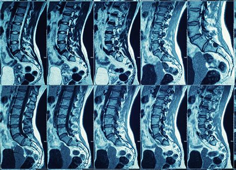 Spinal Imaging Is Offered By Dr Katherine Pulse For Patients Who Need It