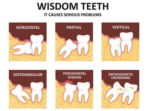Wisdom Teeth Why We Have Them And When To Remove Them Hamburg Dental