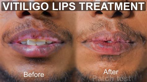 One Step Solution For Vitiligo Lips Organic Process Machu Tattoos
