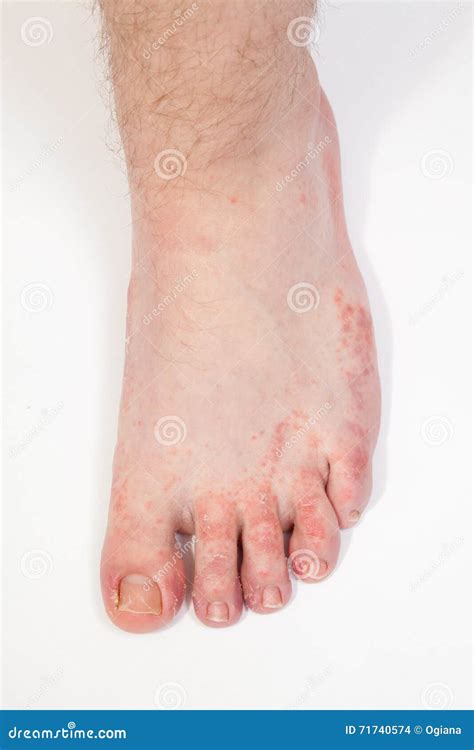 Athlete S Foot Fungi Stock Photo Image Of Feet Inflammation 71740574