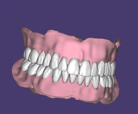 Free Stl File Upper And Lower Full Dentures Teeth And Bases 🦷・3d Print