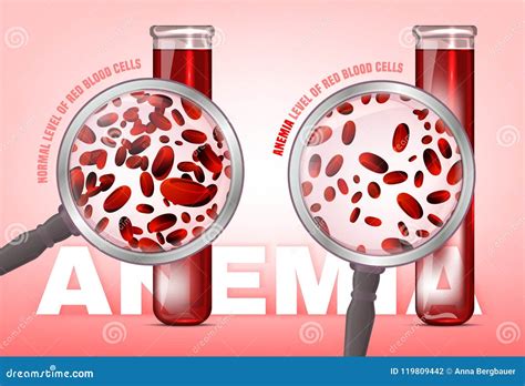 Anemia Level Of Blood Cells Stock Vector Illustration Of Anaemia