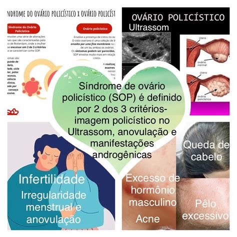#cedhel clinica informa | Ovários policísticos, Anovulação, Síndrome do