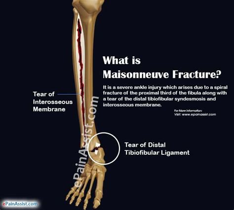 Maisonneuve Fracture Definition Causes Symptoms Diagnosis Treatment