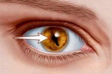 Your cat rubbing, pawing at and/or blinking their eyes. Cat's eye syndrome: causes, symptoms, diagnosis, treatment ...