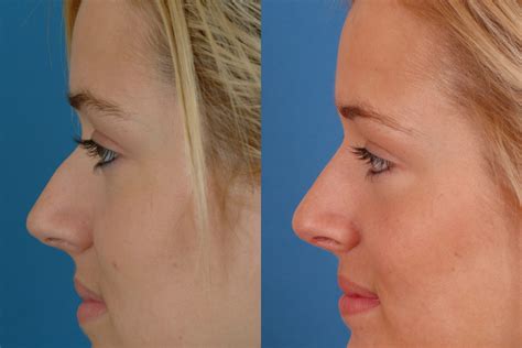 Nasal Surgery Dallas Advanced Facial Plastic Surgery Center