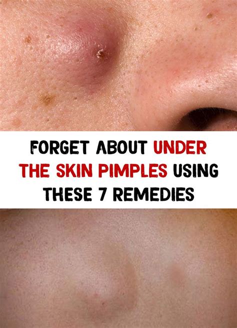 Pimples Under The Skin Painful Pimple Under Skin Back Pimples