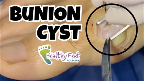 Doctor Removes Cutest Ganglion Cyst From Foot Youtube
