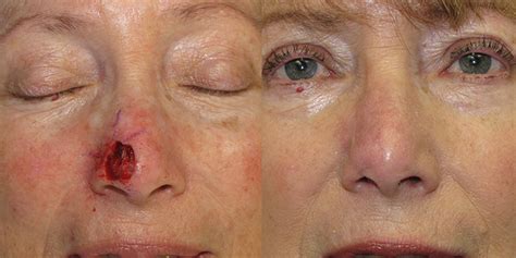 Nose Reconstruction Gallery Skin Cancer And Reconstructive Surgery Center