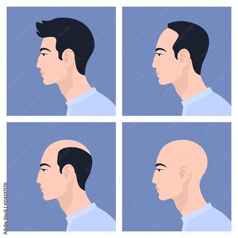 Stages Of Male Pattern Baldness Hair Loss Alopecia Asian Men Vector