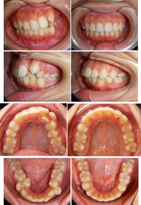 [案例分享] LH牙齒矯正(30)：暴牙笑齦矯正 ： 高雄、台南LH牙齒舌側矯正醫師推薦：蘇桄緯醫師‎