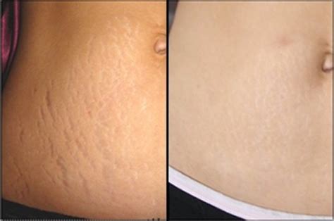 Stretch Marks Striae Treatment Beauty And Laser Clinic