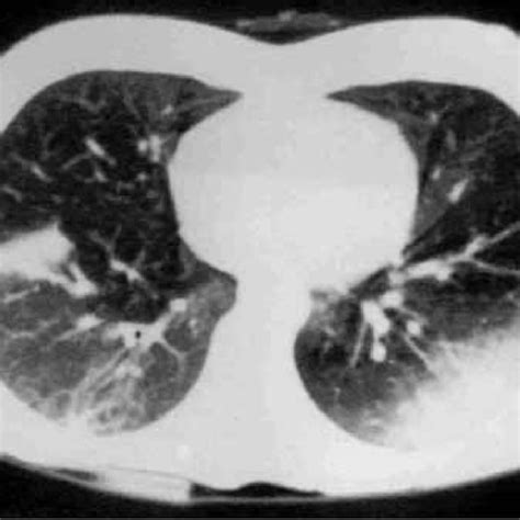 Ct Scan Of The Chest Of A Patient With Acute Exogenous Lipoid