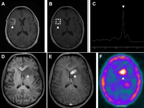 Hiv Related Cerebral Toxoplasmosis Revisited Current Concepts And