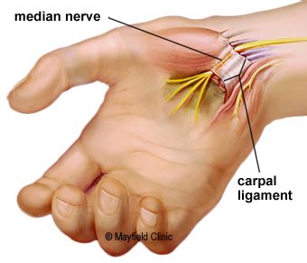 What causes carpal tunnel syndrome (cts). carpal tunnel - Liberal Dictionary
