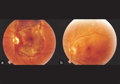 A B Show Preoperative And Postoperative Fundus Findings