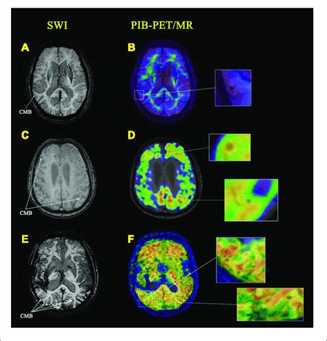 Cerebral Microbleeds Cmbs Identified On Images From Magnetic