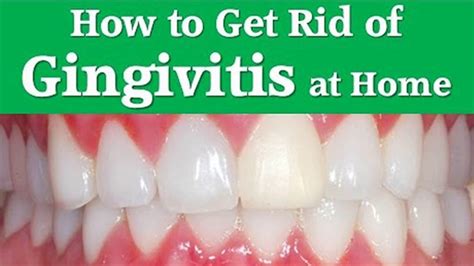 What Is Gingivitis Symptoms Home Remedies To Treat Youtube