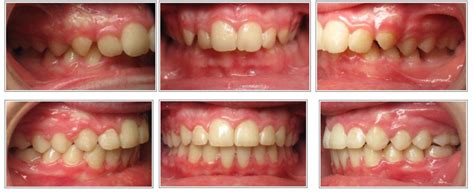 Correction Of An Overbite And Overjet By Dr Kendra Pratt And Team Terramont Orthodontics