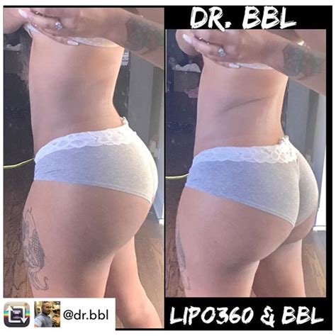 Repost From Dr Bbl Dr Balgobin Making New Instagram Models Everyday