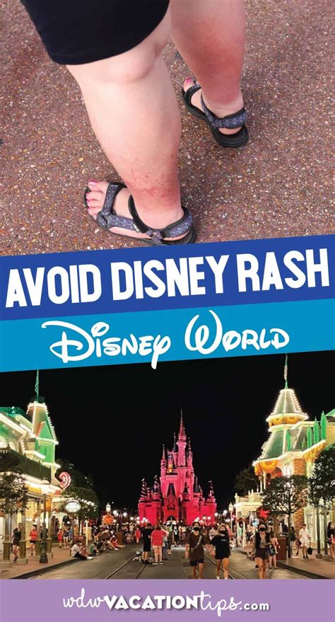 Disney Rash How To Treat And Prevent • Wdw Vacation Tips