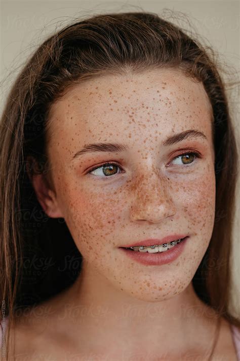 pretty girl with freckles and braces by liliya rodnikova stocksy united